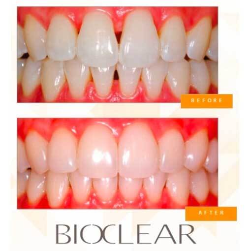Bonding-with-the-Bioclear-method Bonding-with-the-Bioclear-method