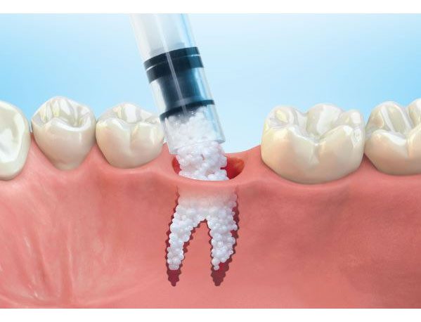 Bonegraft Lifetime Dental