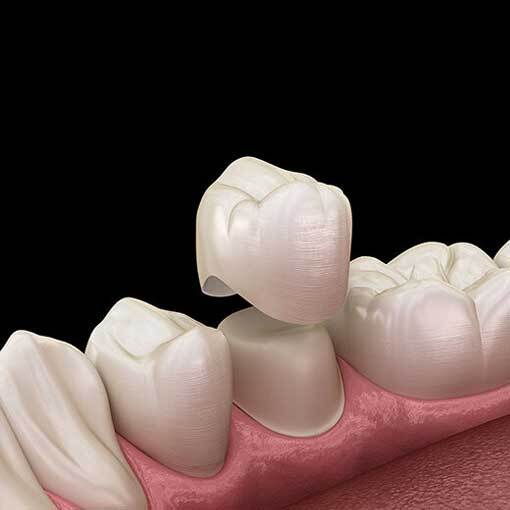 Dental-Crowns Dental-Crowns