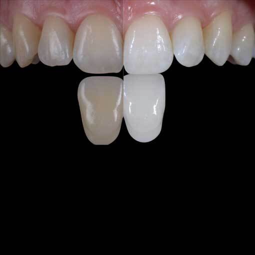 Teeth-Whitening Teeth-Whitening