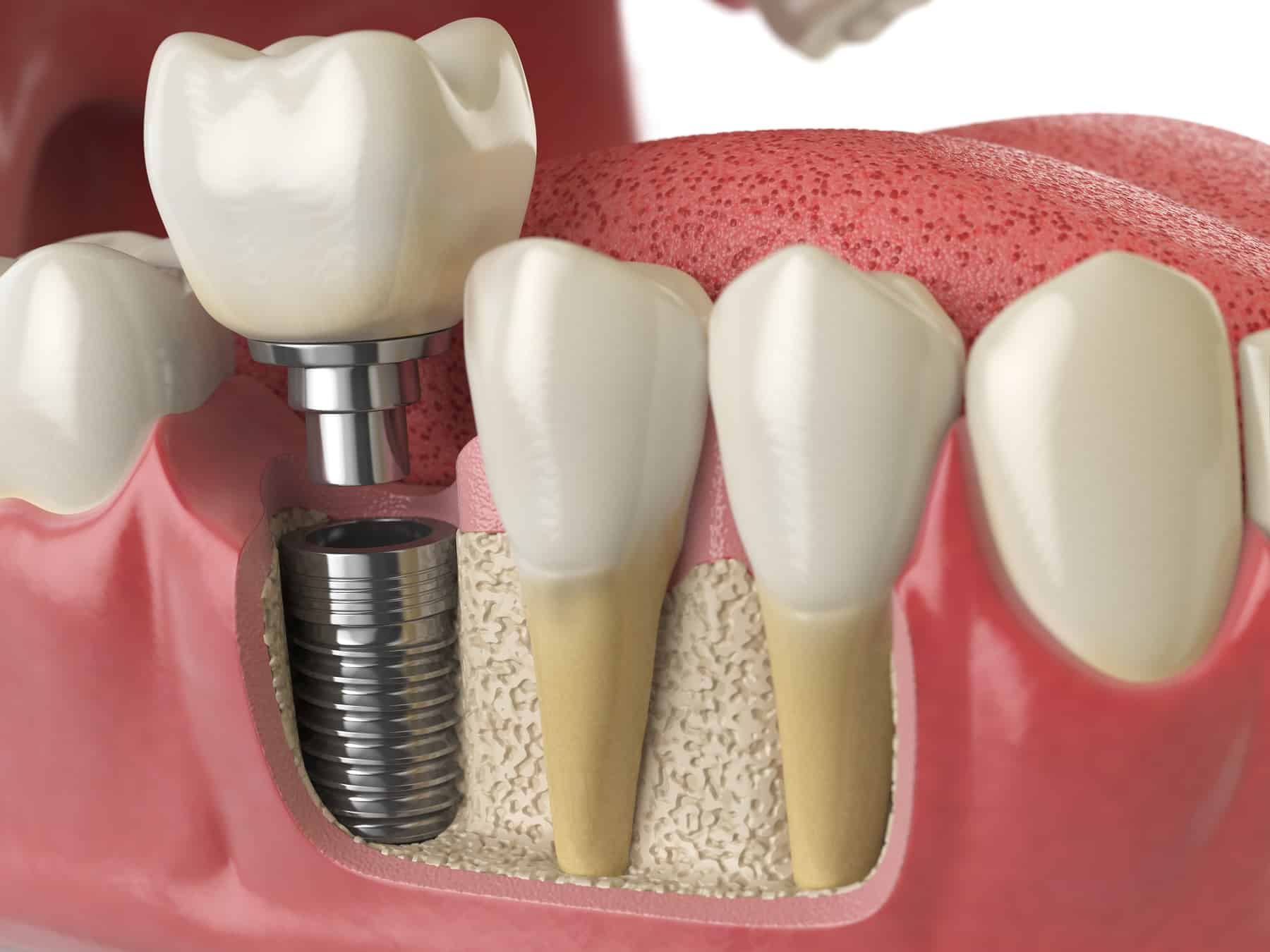 implant Lifetime Dental