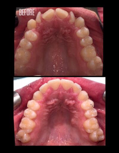 Invisalign before and after above